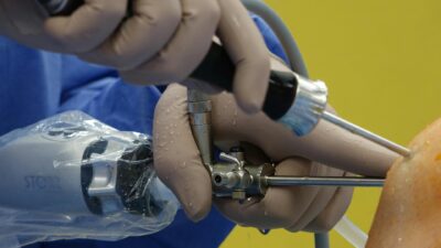 Endoscopia da Coluna: Benefícios e Recuperação para Alívio da Dor Crônica